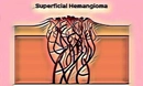 Hemanjiom Nedir Hemanjiom Tedavisi Nasıl Yapılır? Hemanjiom Nedir Hemanjiom Tedavisi Nasıl Yapılır?