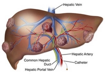 Karaciğer Hemanjiom Belirtileri ve Tedavisi Karaciğer Hemanjiom Belirtileri ve Tedavisi