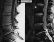 Vertebra Korpusunda Hemanjiom Belirtileri ve Tedavisi Vertebra Korpusunda Hemanjiom Belirtileri ve Tedavisi
