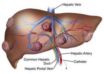 Karaciğer Hemanjiom Ağrısı Belirtileri ve Tedavisi Karaciğer Hemanjiom Ağrısı Belirtileri ve Tedavisi