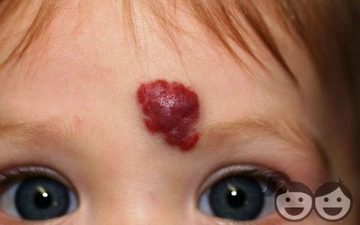 Yüzde Hemanjiom Belirtileri ve Tedavisi Yüzde Hemanjiom Belirtileri ve Tedavisi