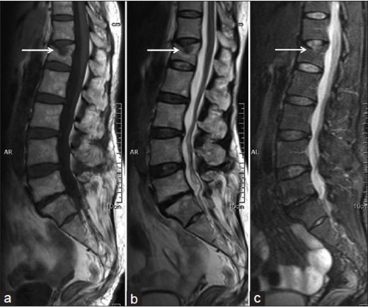 L1 Vertebra Korpusunda Hemanjiom Nedir