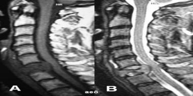 T2 Vertebra Korpusunda Hemanjiom Nedir